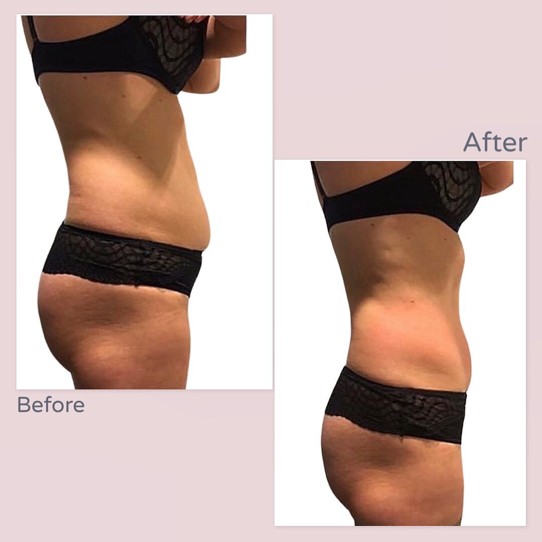 Before and after 3 treatments on the tummy.. Want to start your summer body transformation now? Contact us today!