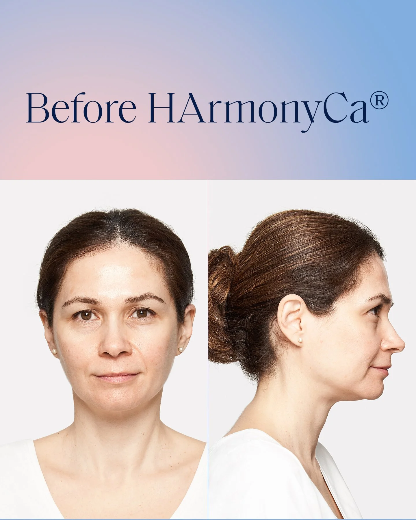 Harmonyca london ontario, biostimulators, bioregenerative - radiesse