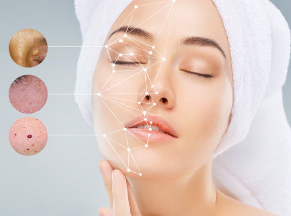 ThermoClear London Ontario,  Skin tag removal London Ontario, Milia removal London Ontario