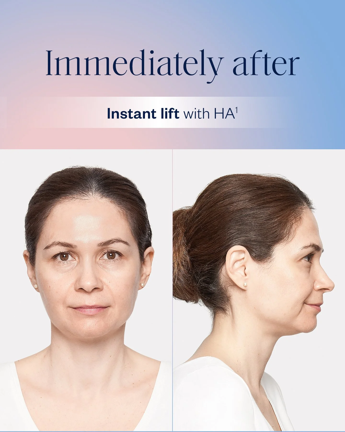 Harmonyca london ontario, biostimulators, bioregenerative - radiesse