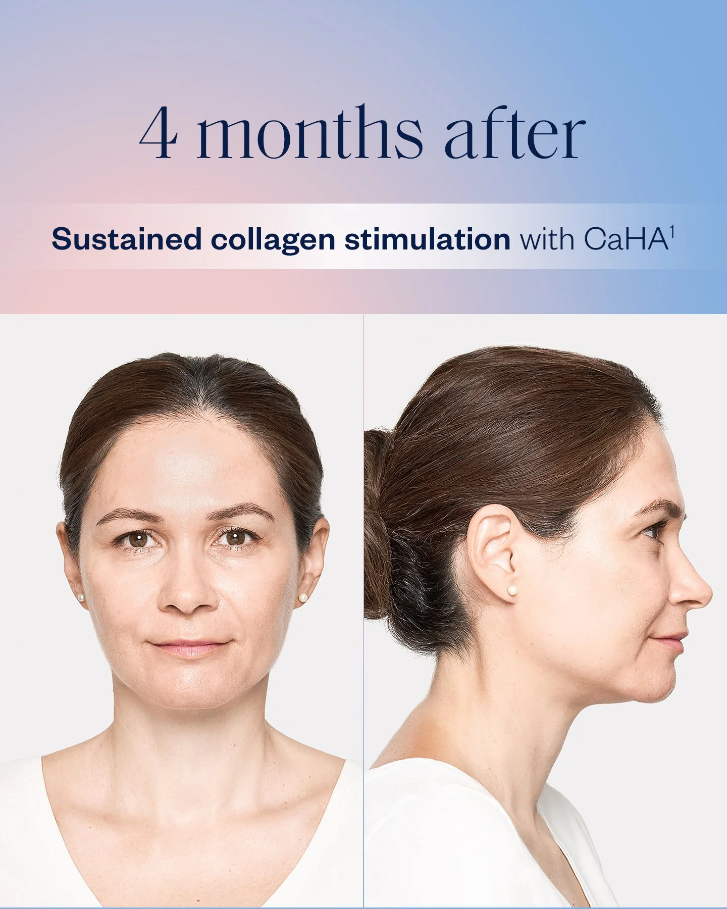 Harmonyca london ontario, biostimulators, bioregenerative - radiesse