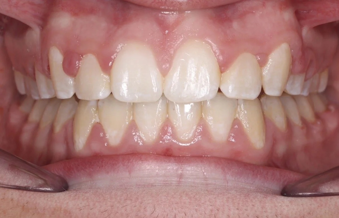 AFTER – Teeth successfully aligned, creating a straighter and more balanced smile.