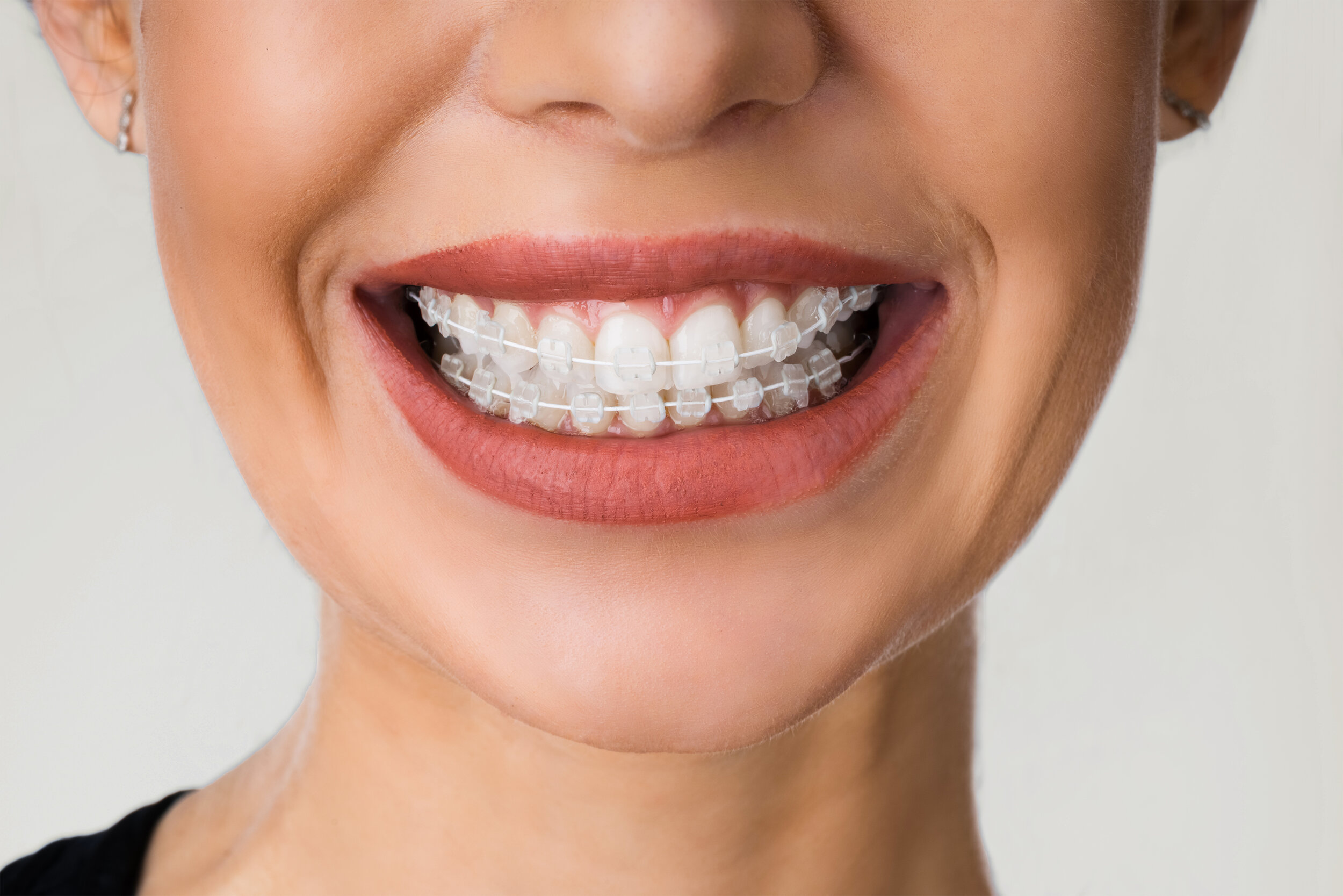 Ceramic Braces  Straight Teeth — South Beach Clinic