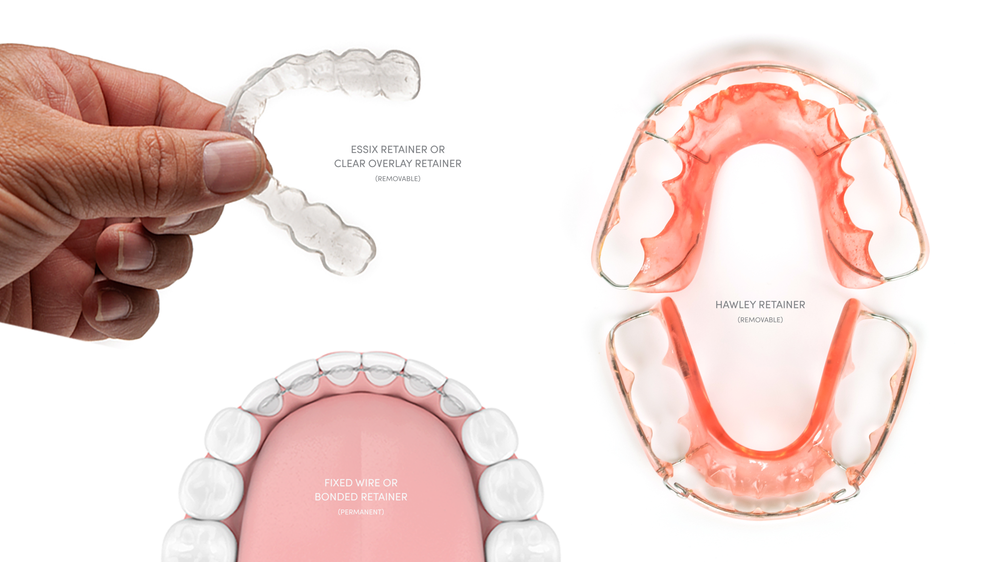 Types of Retainers | Greystones, Ireland — South Beach Clinic