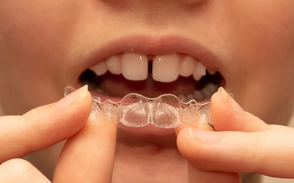 Does Invisalign Hurt? Common Questions Answered