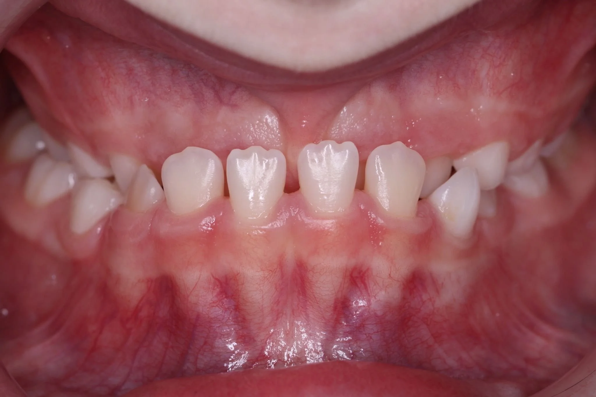 BEFORE - Limited space, developing bite issues, and restricted jaw growth.