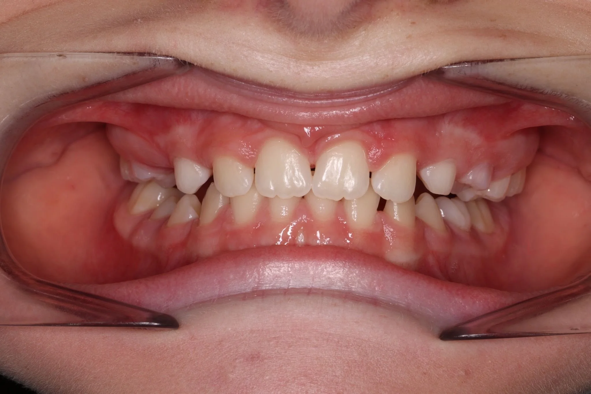 AFTER - Improved space and bite using a Hybrid RME (with TADs), supporting healthy jaw development and a more stable long-term result.