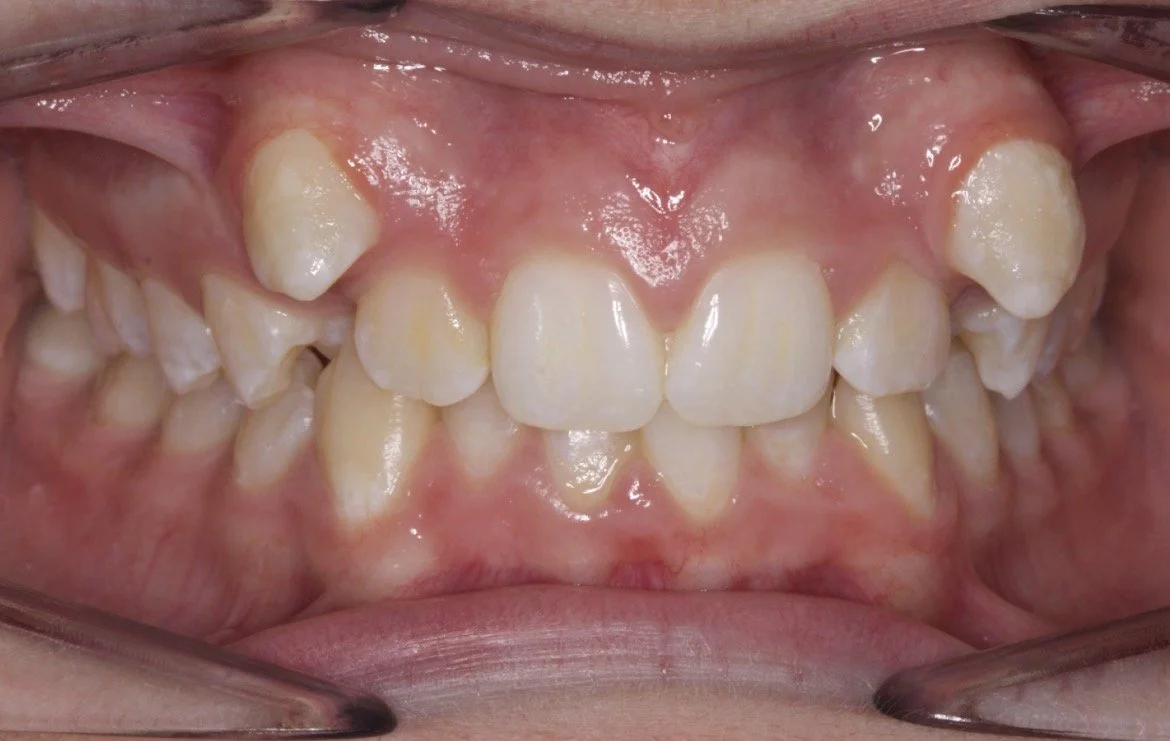 BEFORE – Crowded upper teeth with prominent canines and significant misalignment.