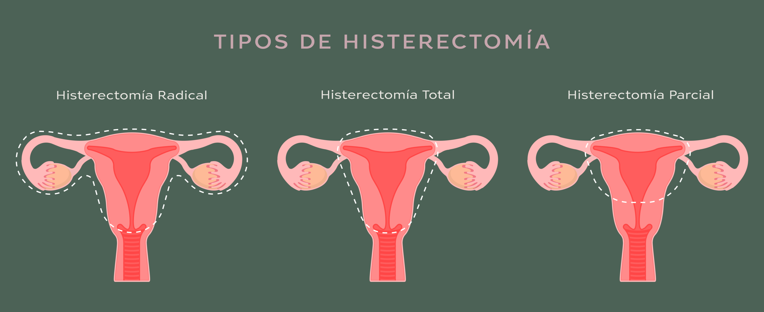 Preguntas frecuentes Histerectomía — Dra. Vallejo