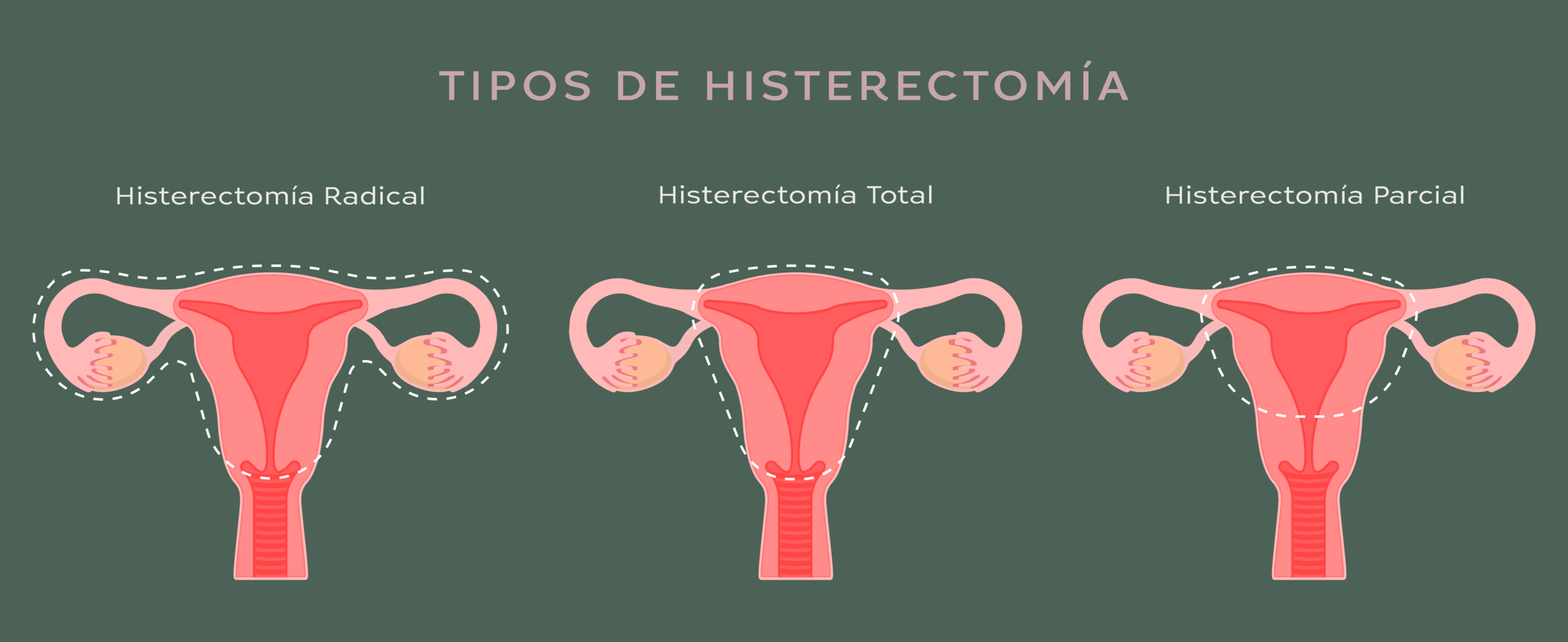 A la extirpación quirúrgica de uno o ambos ovarios se le llama