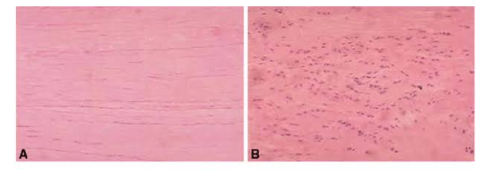 healthy tendon tissue tendinosis tissue