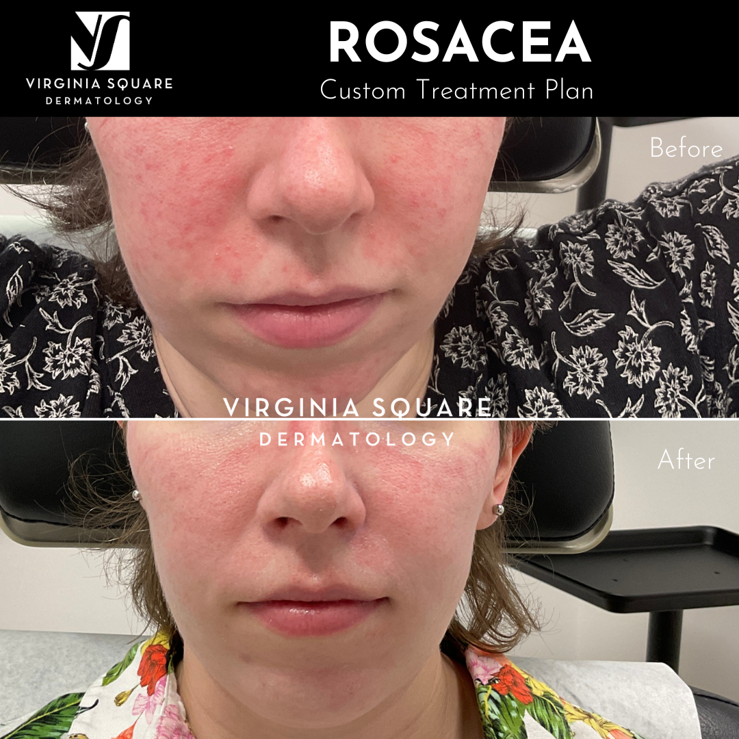 Rosacea.png