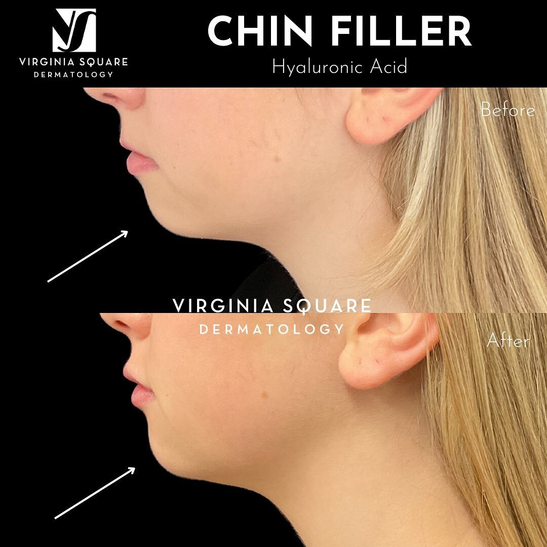 ✨ Achieve better facial harmony with chin filler! This non-surgical procedure adds volume and definition to the chin, enhancing your side profile. 

#ChinFiller #ProfileBalancing #FacialHarmonization #arlingtonva #arlingtondermatologist #dcdermatolog