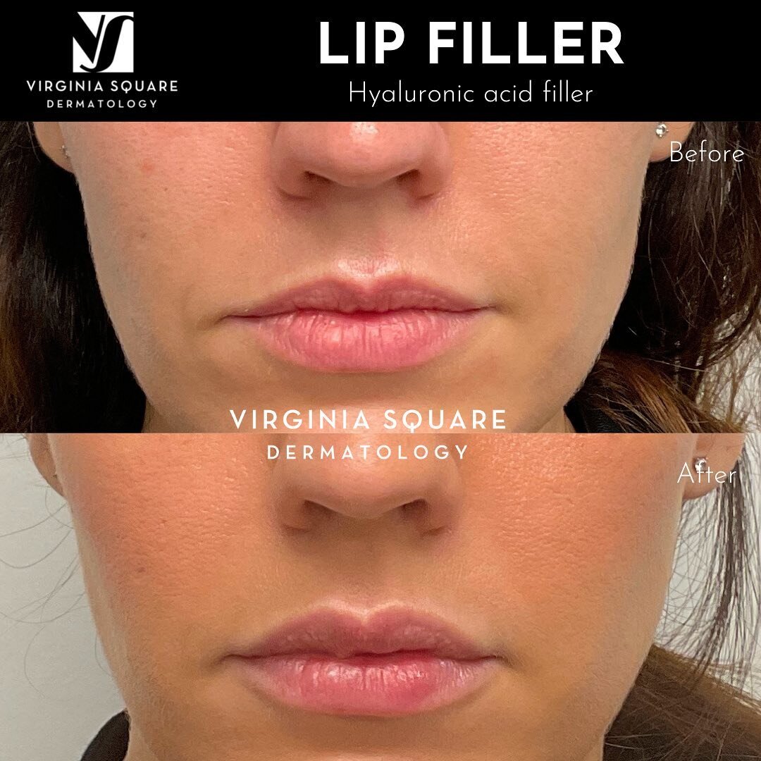 Lips that look more youthful and feminine- but never &ldquo;done&rdquo;. Dr. Jones prides herself in helping patients achieve natural looking results - with safety and mindfulness of long term implications at the forefront of her mind. 

Dr. Jones fi