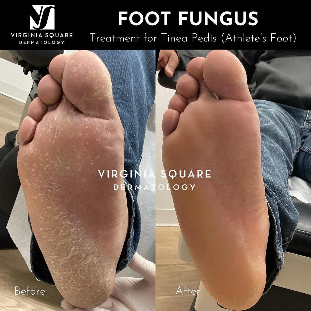 Think this is just dry skin? Think again. Our doctors properly diagnosed this patient with tinea pedis (athlete&rsquo;s foot). It is often misdiagnosed as eczema or dry skin. 

It is easy to catch this fungus at the pool and locker room. It also love