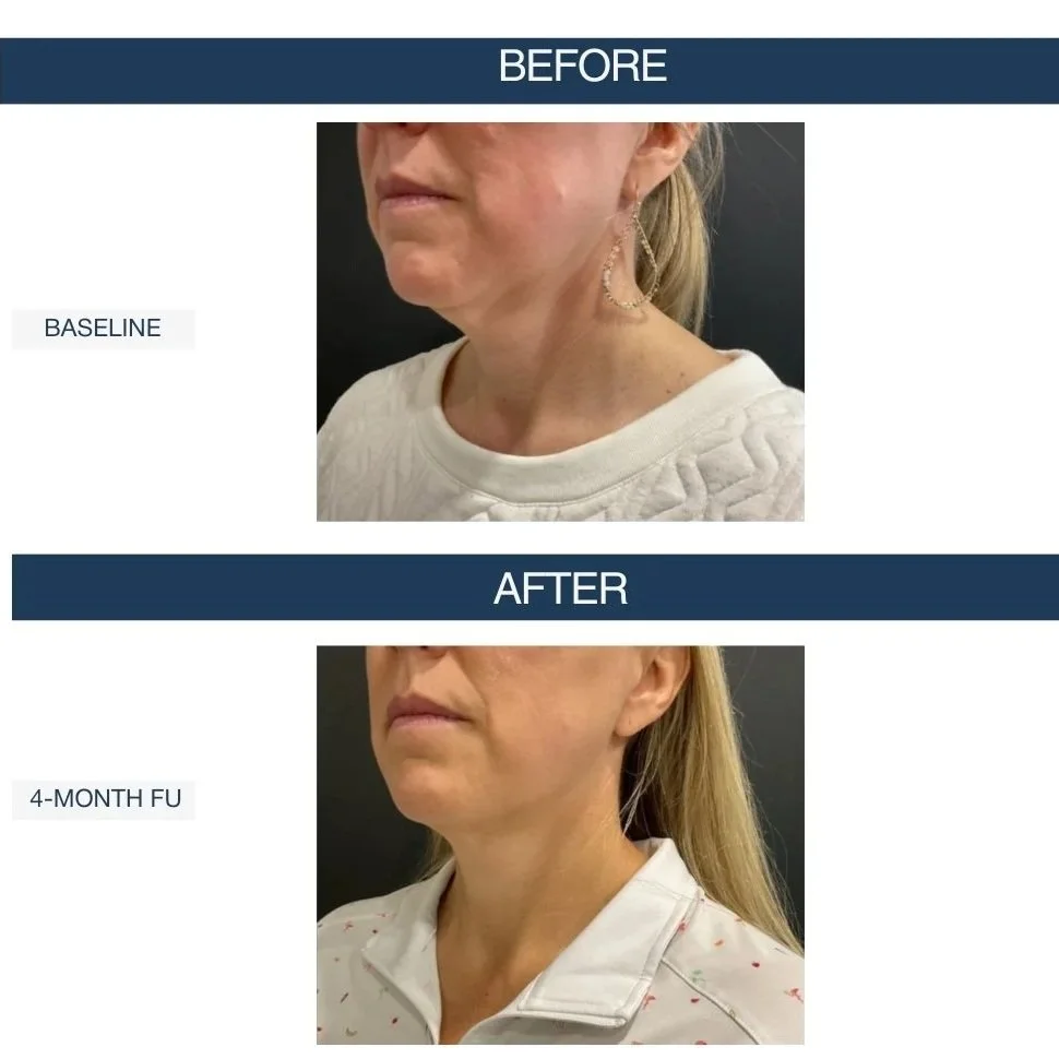 The Science of Non-Surgical Skin Tightening: Why Sofwave is the Preferred Lift in Northern Virginia