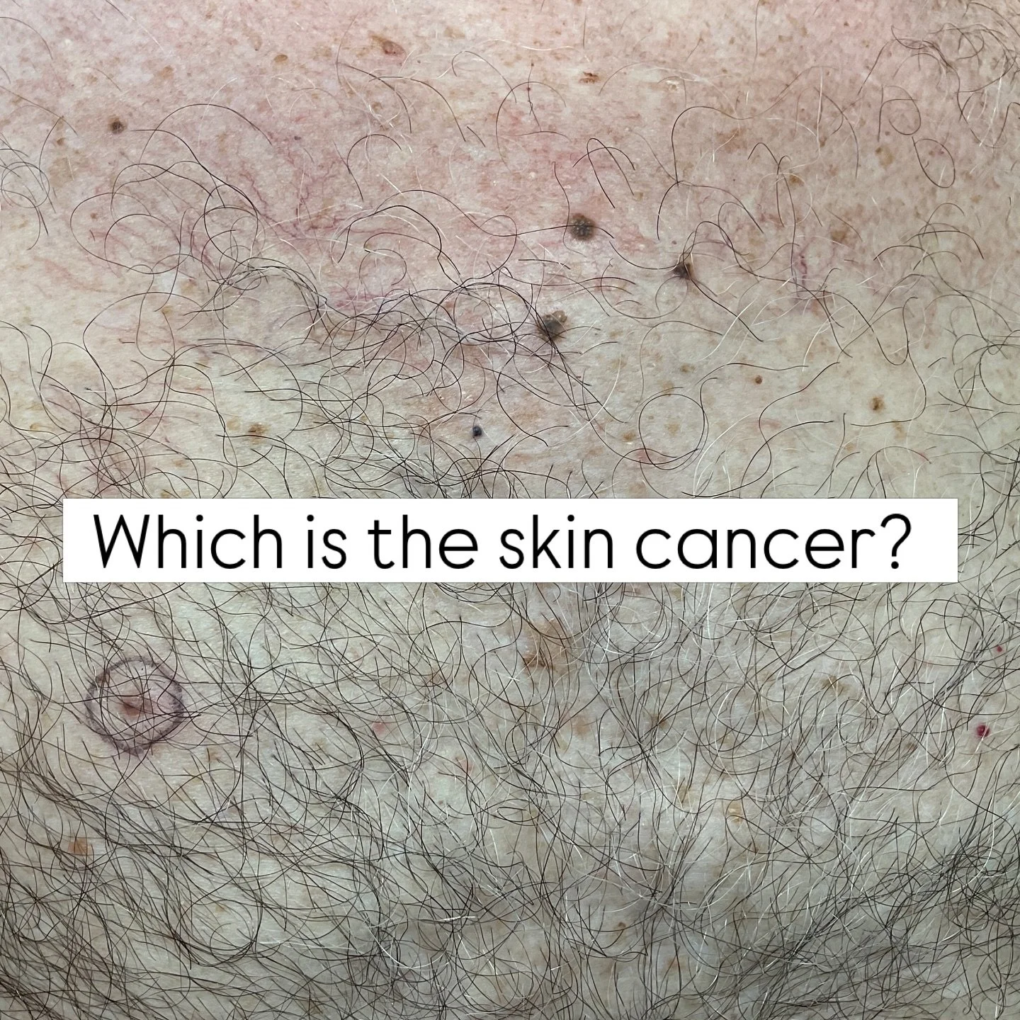 During skin cancer screenings, our dermatologists will check every spot on your skin looking for signs of skin cancer. This patient has multiple dark moles, making it difficult for him to know what is concerning. Our doctor was able to catch a skin c
