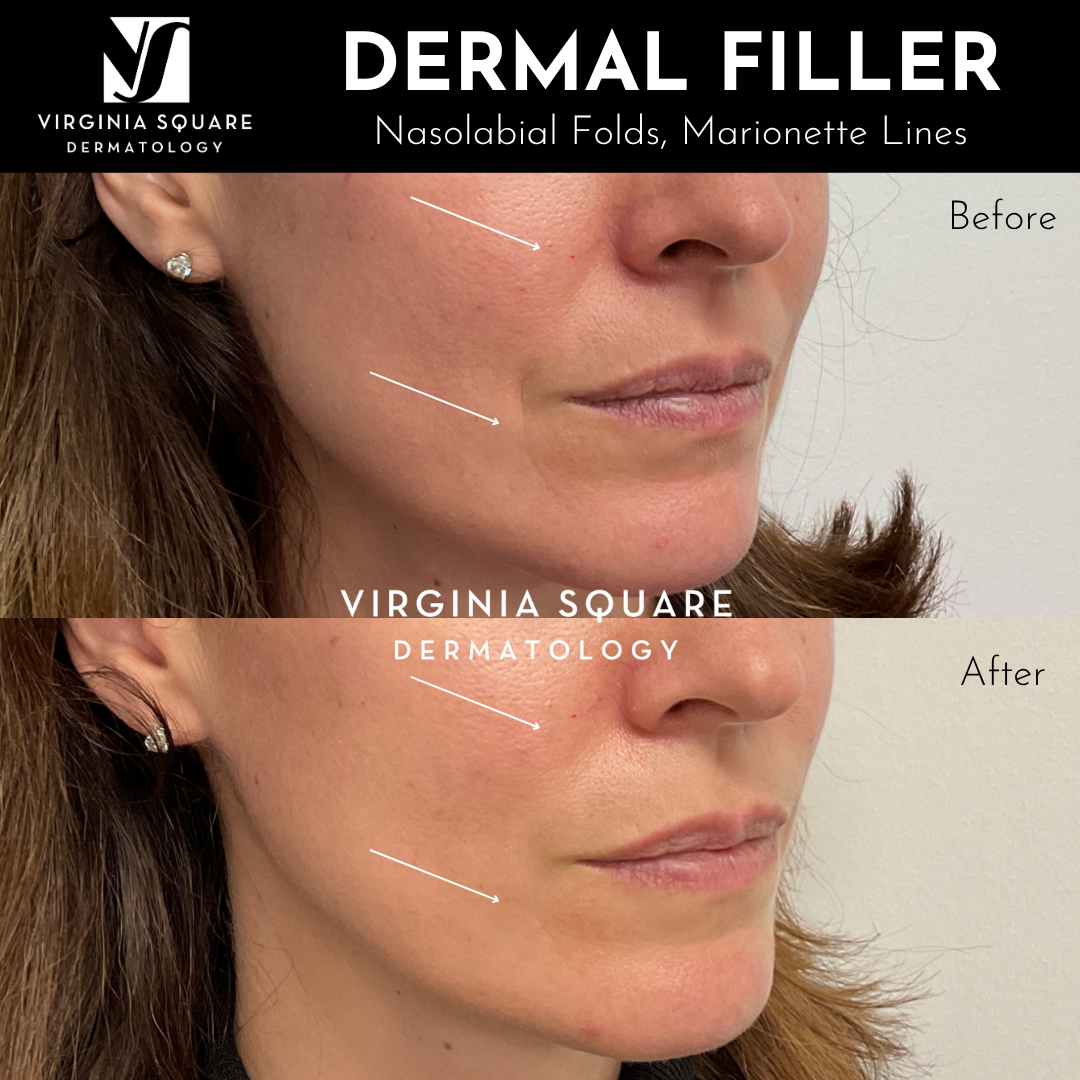Dermal+Filler+%281%29.png