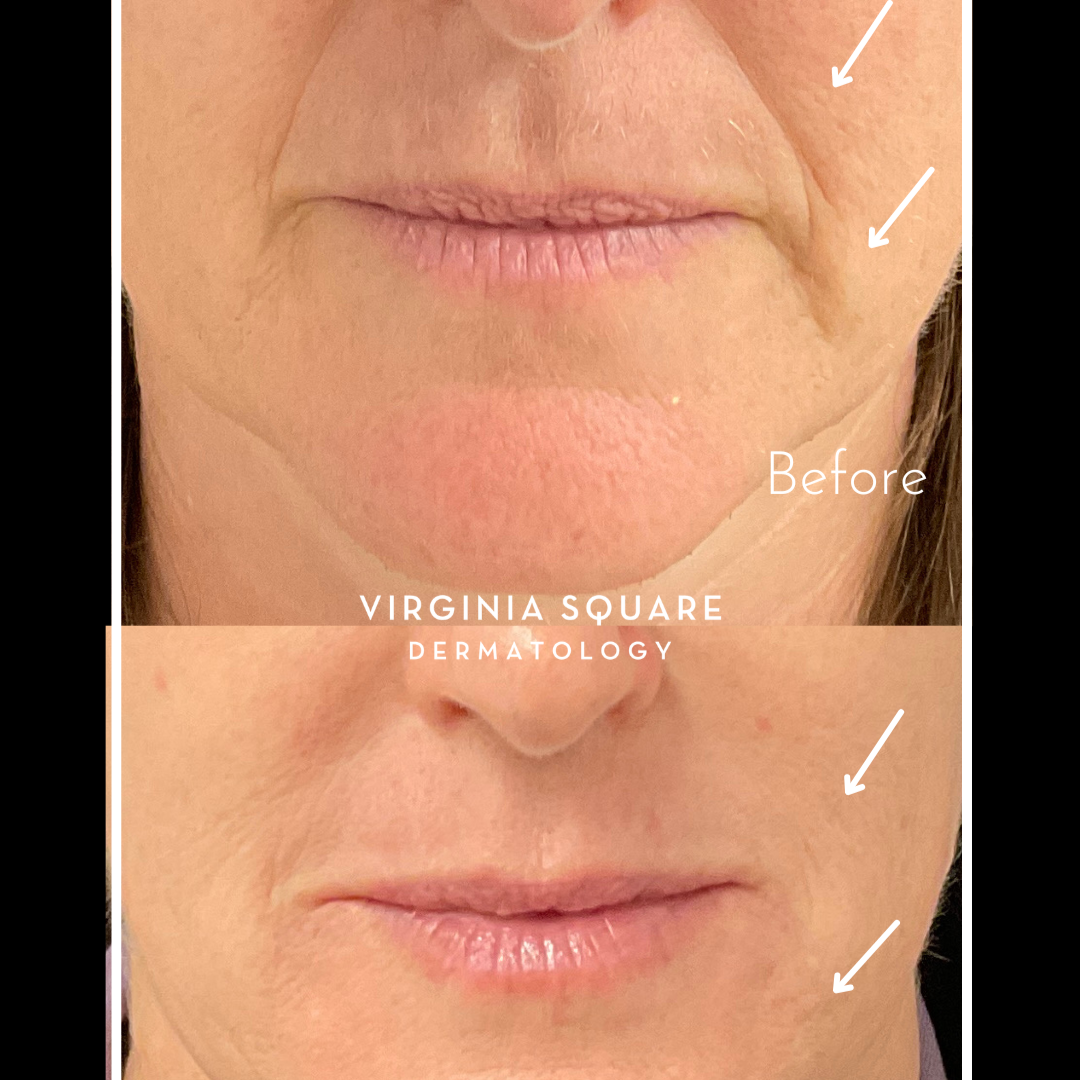 Perioral+Filler.png