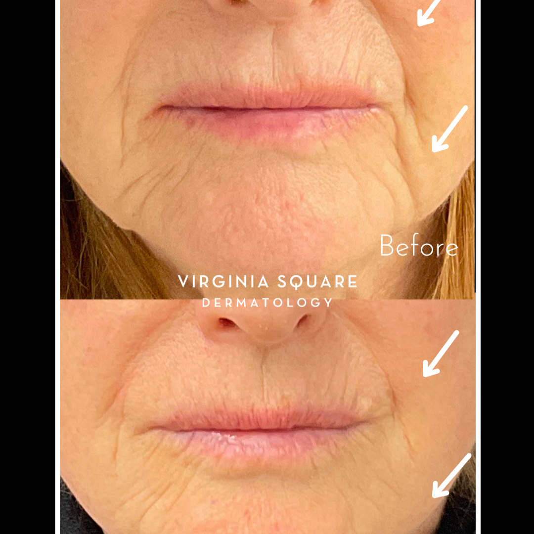 Nasolabial+fold%2C+marionette+lines%2C+and+lips.png