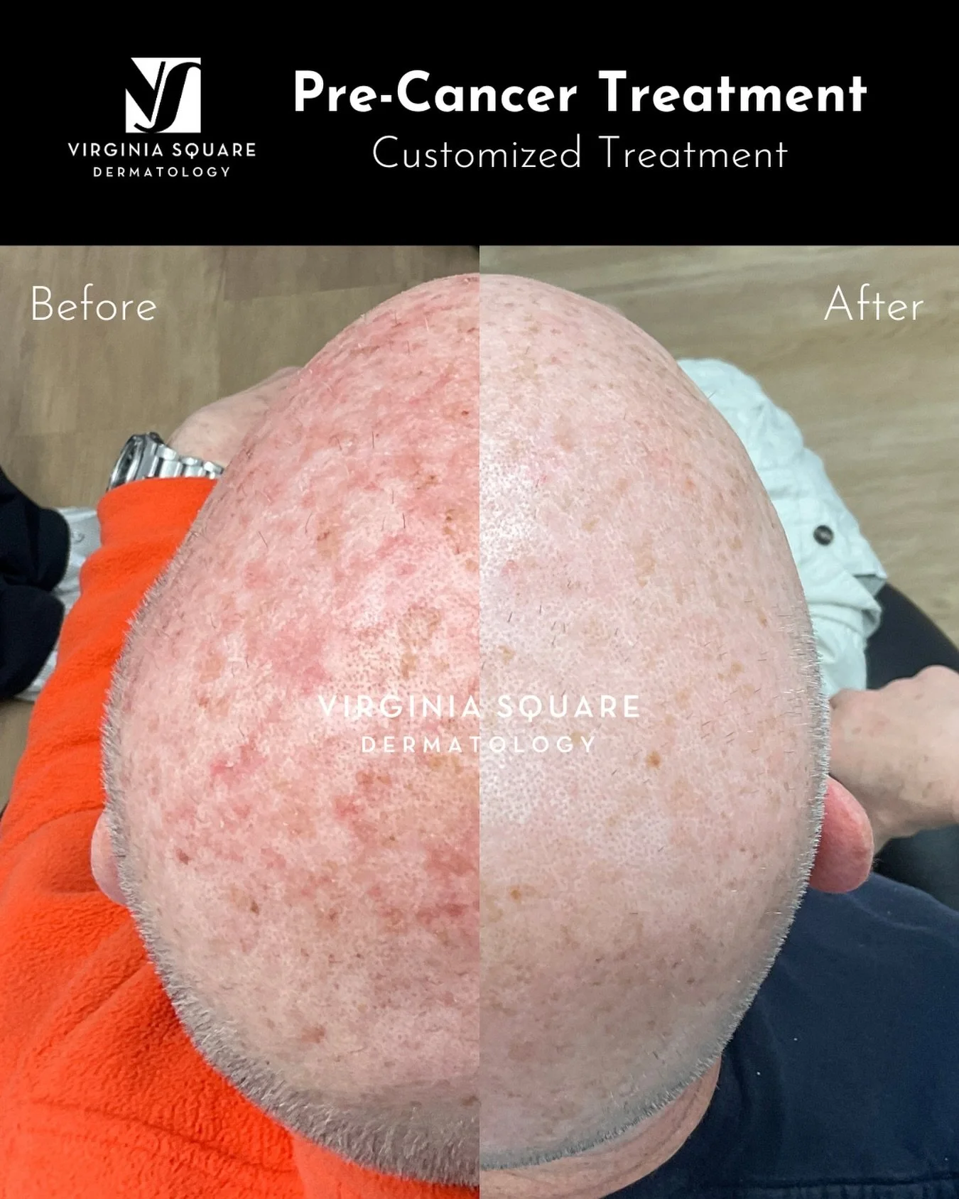 Sun damage accumulates over time, often showing up as actinic keratoses (rough, scaly spots). Left untreated, these pre-cancerous lesions can develop into skin cancer&mdash;but with targeted treatment, we can clear the damage and restore healthy skin