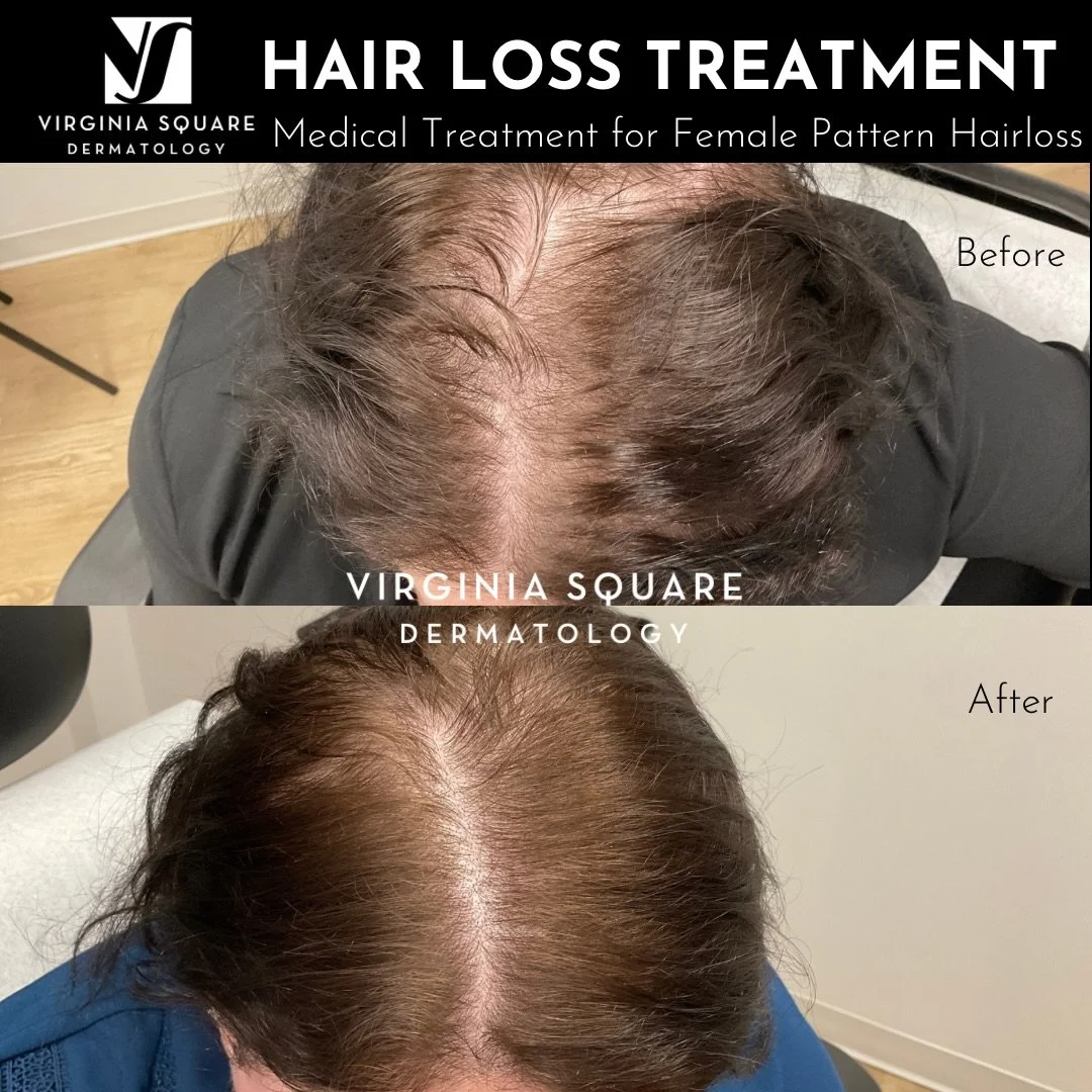 Ready to *fall* in love with your hair again? ✨

Female pattern hair loss is extremely common, but you don&rsquo;t have to navigate it alone. This patient saw incredible density restoration using a personalized treatment plan tailored specifically to