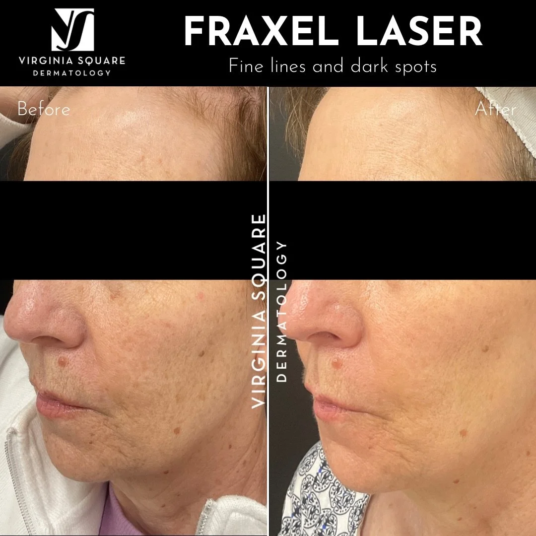 This is a reminder to book that Fraxel treatment, especially before the schedule fills up! ✨

Our team highly recommends a yearly Fraxel to clean up dark spots, smooth texture, and target fine lines. As a big bonus, Fraxel targets precancerous skin l