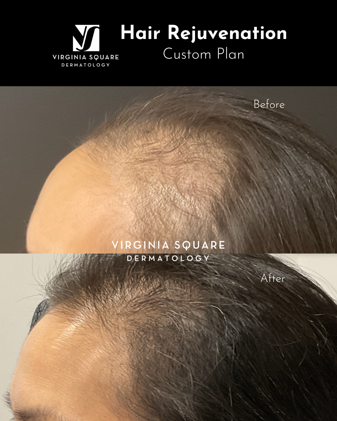 Before and after images showing hair rejuvenation treatment, with the top labeled 'Before' showing thinning hair and the bottom labeled 'After' showing thicker, fuller hair, for Virginia Square Dermatology.