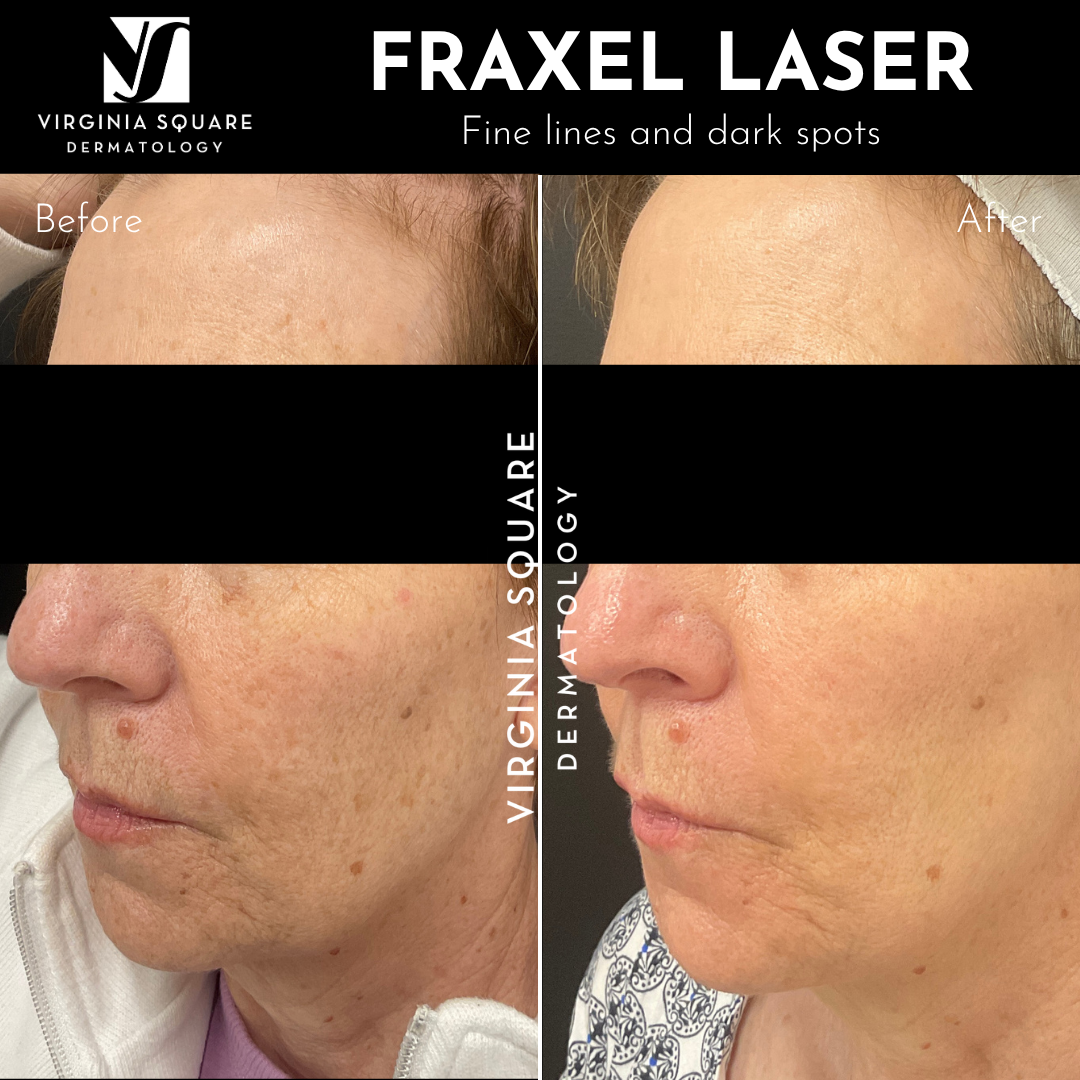Before and after photos showing skin improvement after Fraxel laser treatment, with the top row highlighting fine lines and dark spots, and the bottom row showing a woman with improved skin texture and tone.