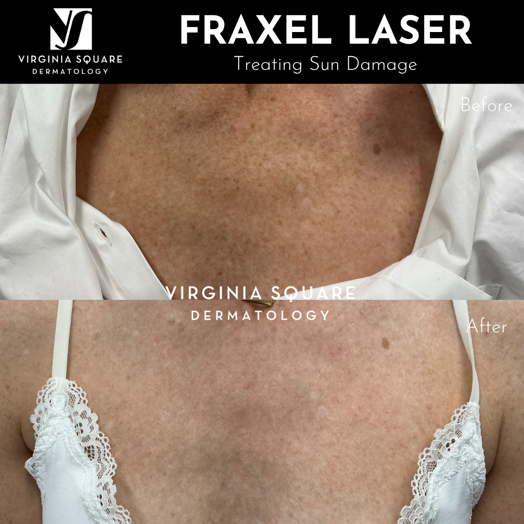 Before and after images of sun damage treatment on the chest, showing improved skin appearance after Fraxel laser treatment at Virginia Square Dermatology.