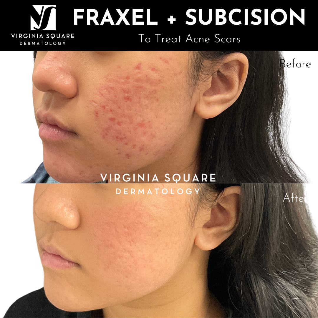 Acne Treatment.png