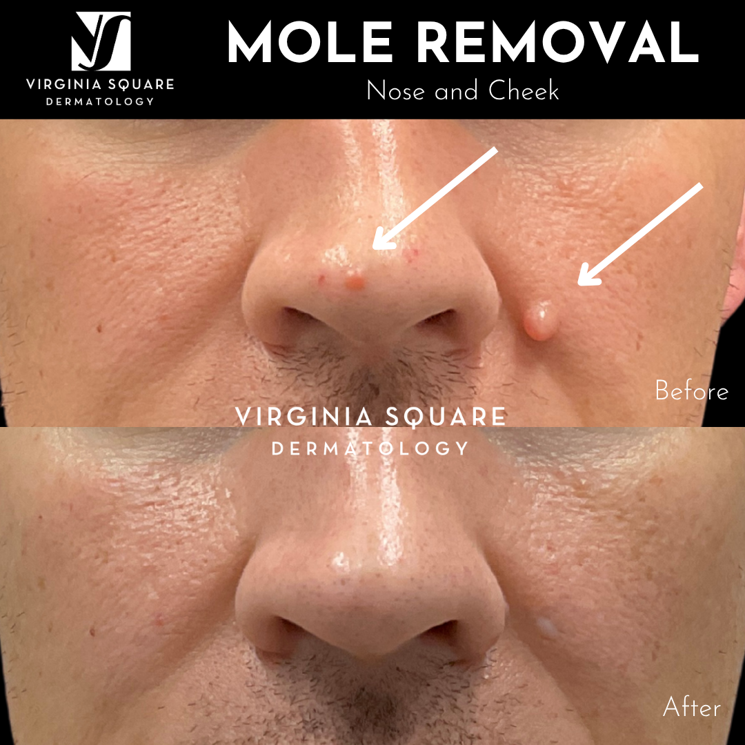 Mole Removal_VSD.png