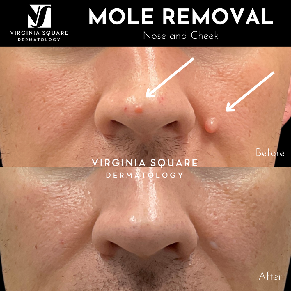 Square Mole Mole Removal — Virginia Square Dermatology - Isabela Jones, MD