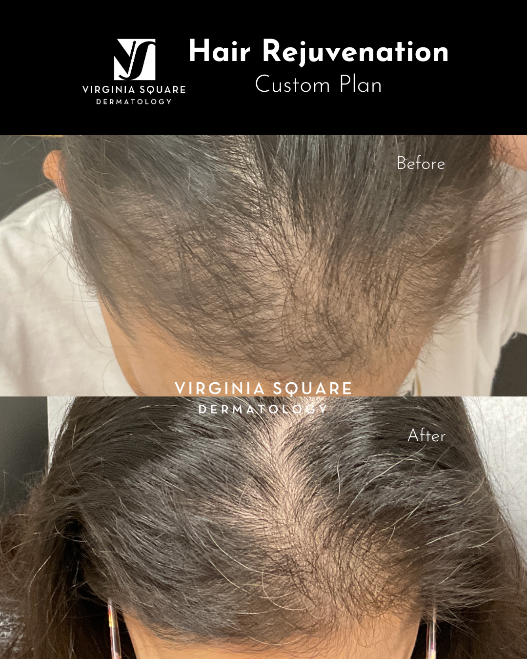 Before and after images showing hair restoration results, with the top image labeled 'Before' showing thinning hair and the bottom labeled 'After' showing thicker hair.