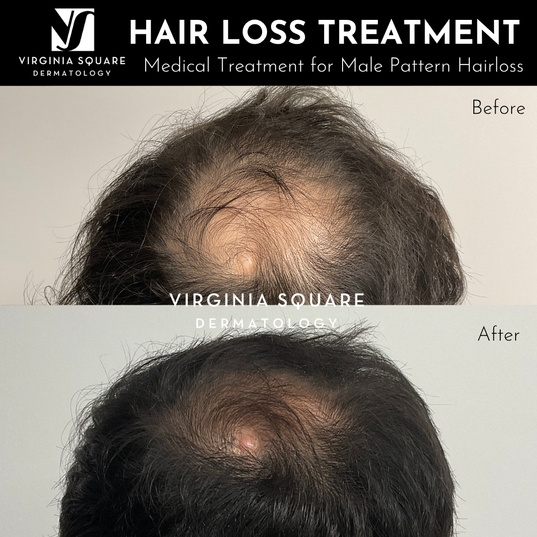 Before and after photos showing a man's scalp with hair loss before treatment and improved hair coverage after hair loss treatment at Virginia Square Dermatology.