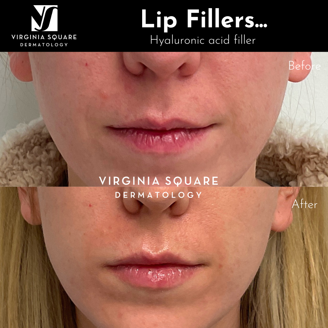 Lip Filler