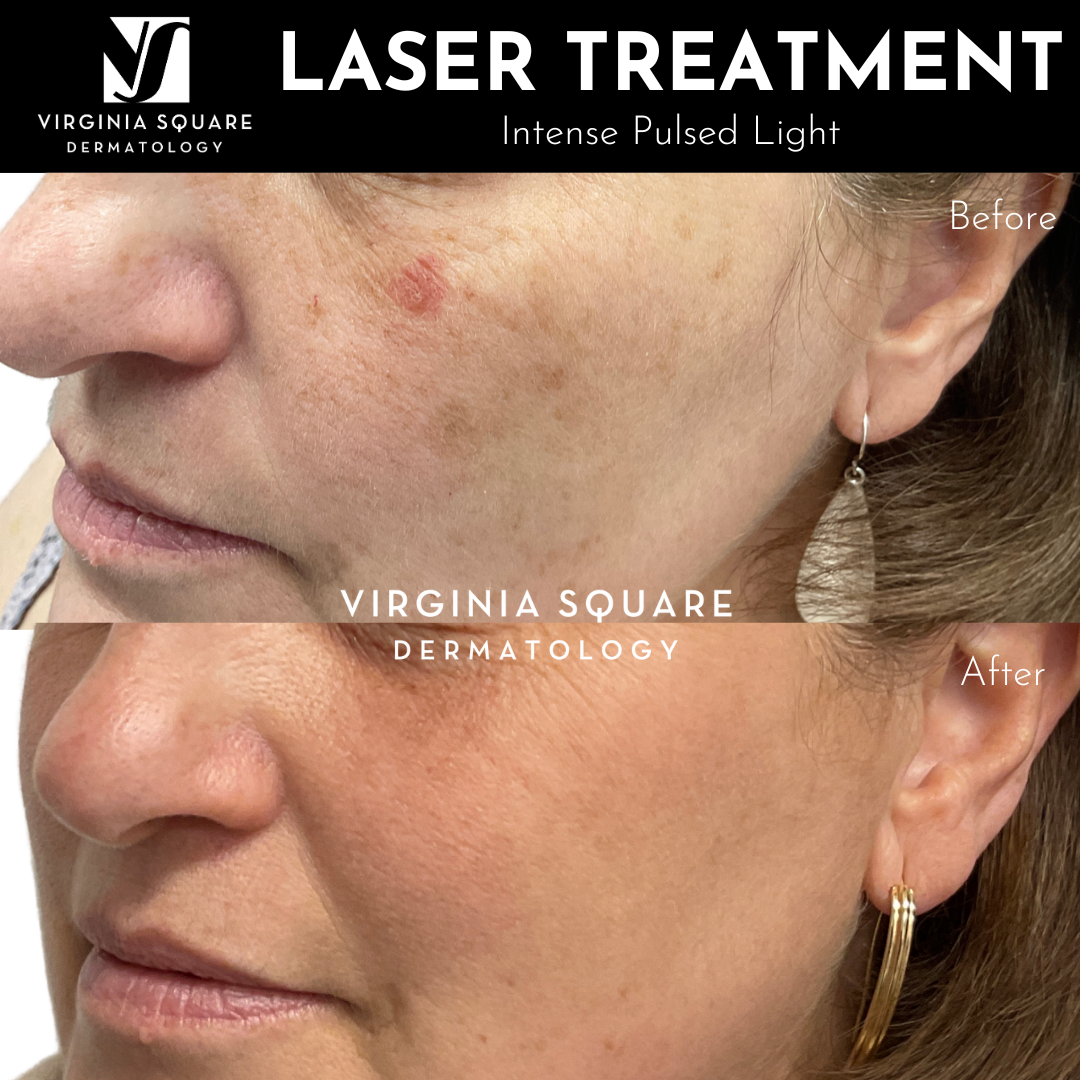 Laser Treatment.png