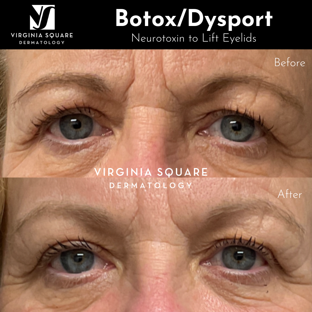 Eyelid Lift.png