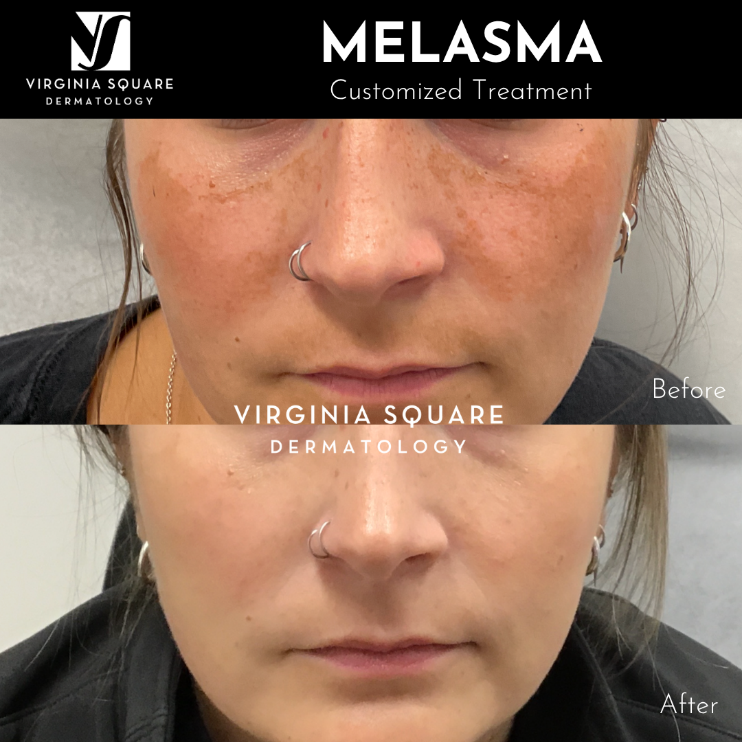 Before and after photos of a woman showing skin improvement after melasma treatment at Virginia Square Dermatology, with text indicating a customized treatment.