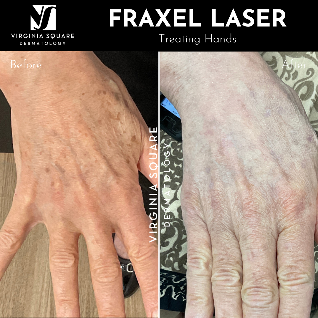 Side-by-side comparison of a hand before and after Fraxel laser treatment, showing improved skin texture and reduced pigmentation at Virginia Square Dermatology.