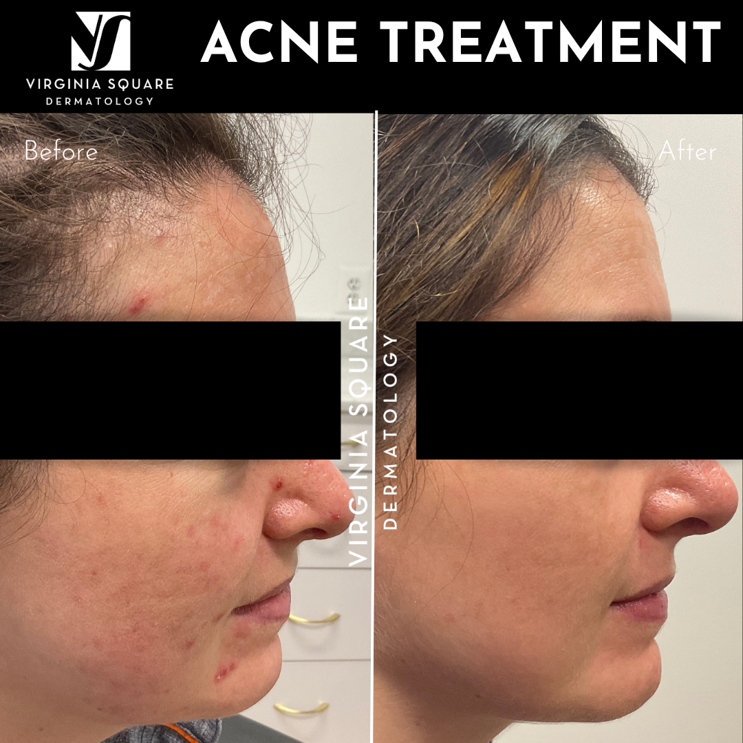 Acne Treatment (4).png