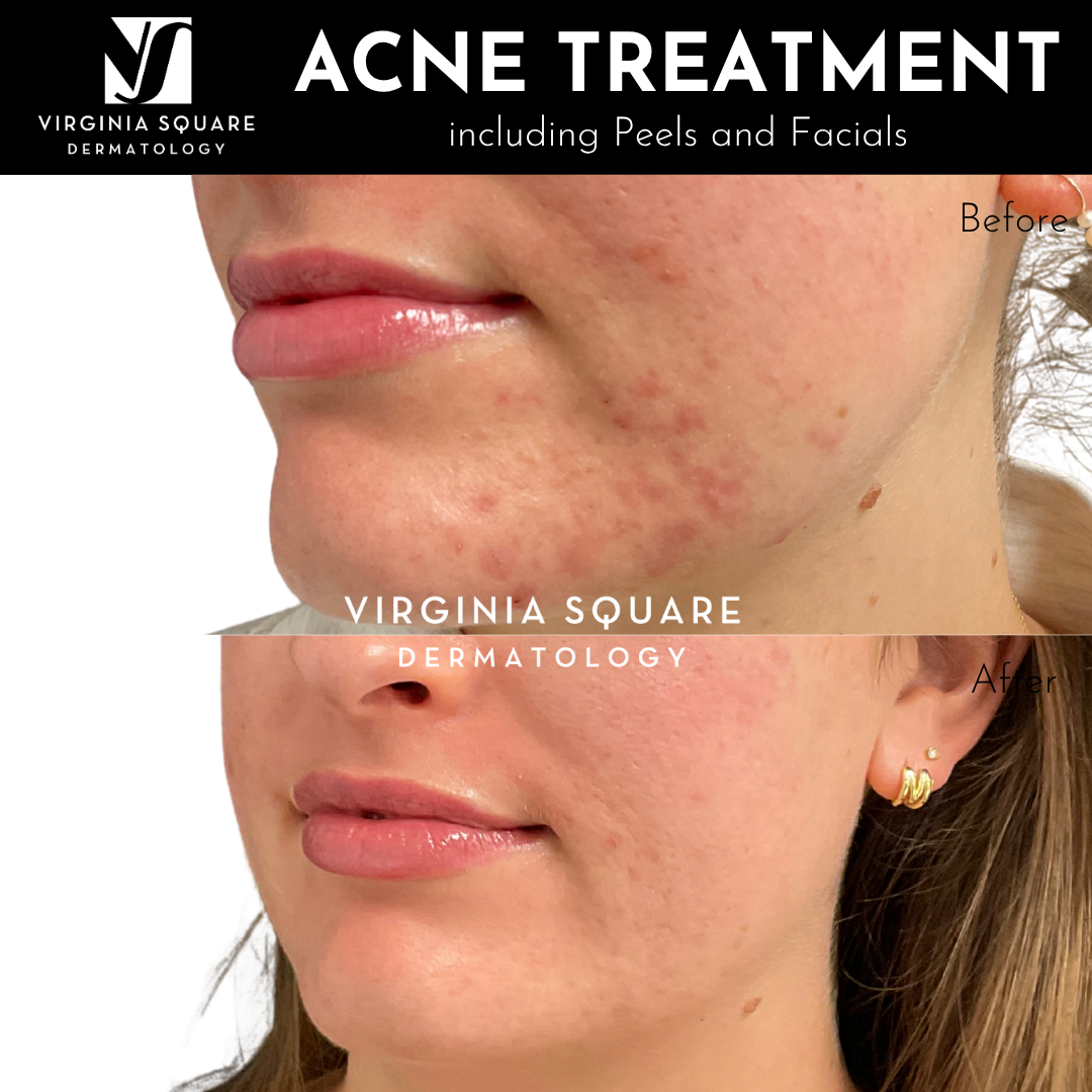Acne Peels and Facials.png