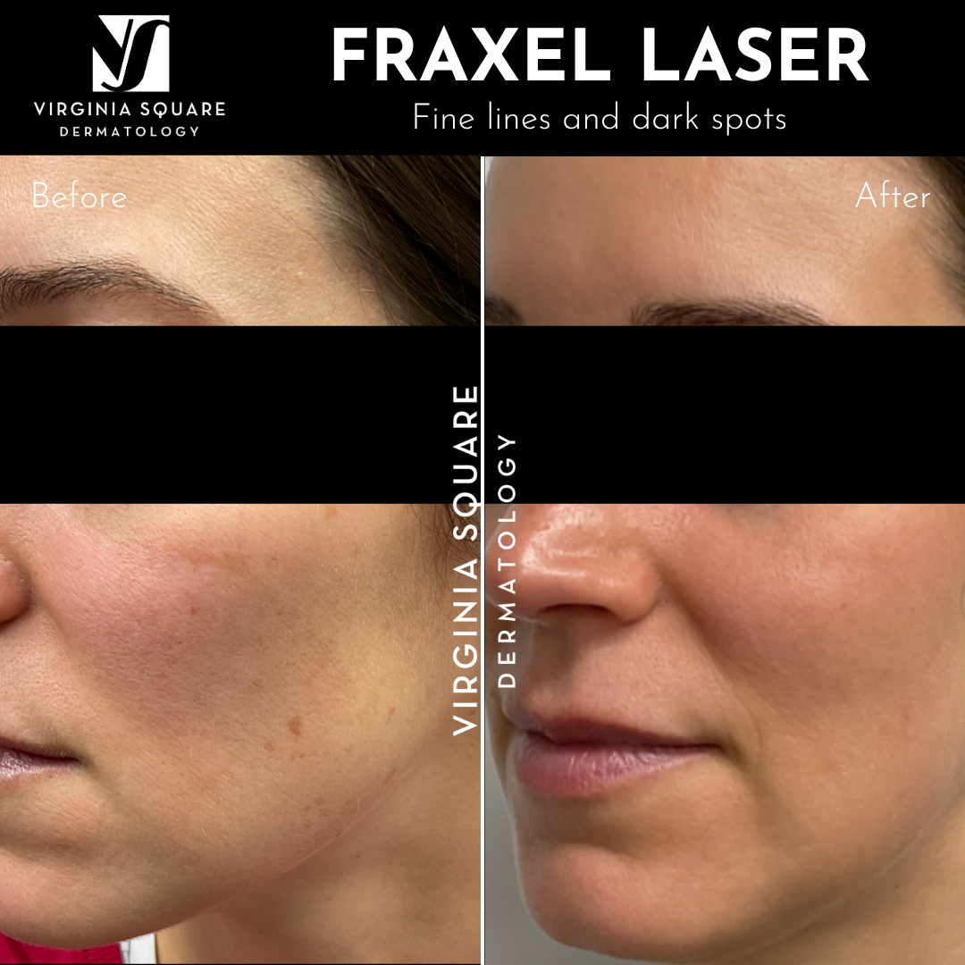 A before and after comparison of skin treatment showing reduction in fine lines and dark spots on a woman's face, with the text 'Fraxel Laser' and 'Virginia Square Dermatology'
