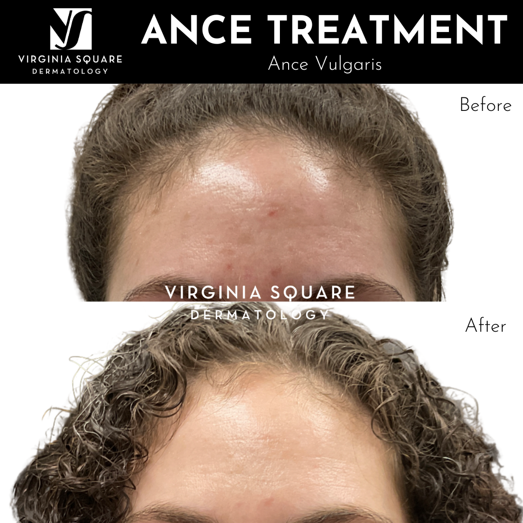 Acne Treatment_VSD.png