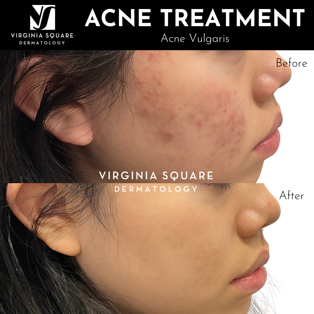 Acne Treatment (5).png
