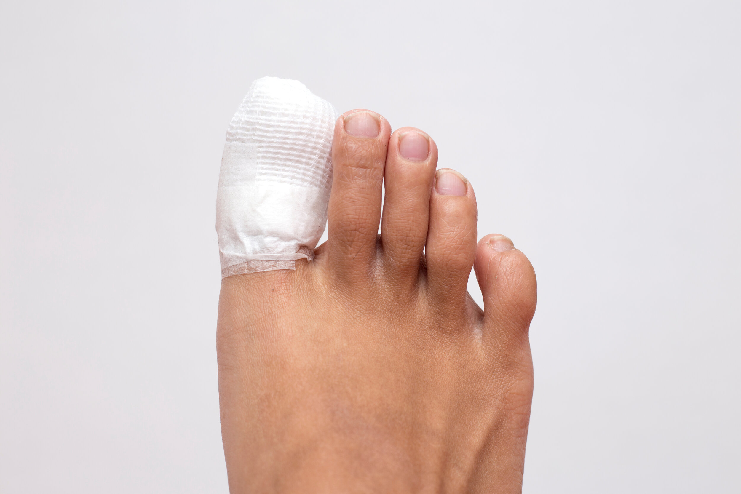 Ingrown toenail - The Foot Force Podiatry