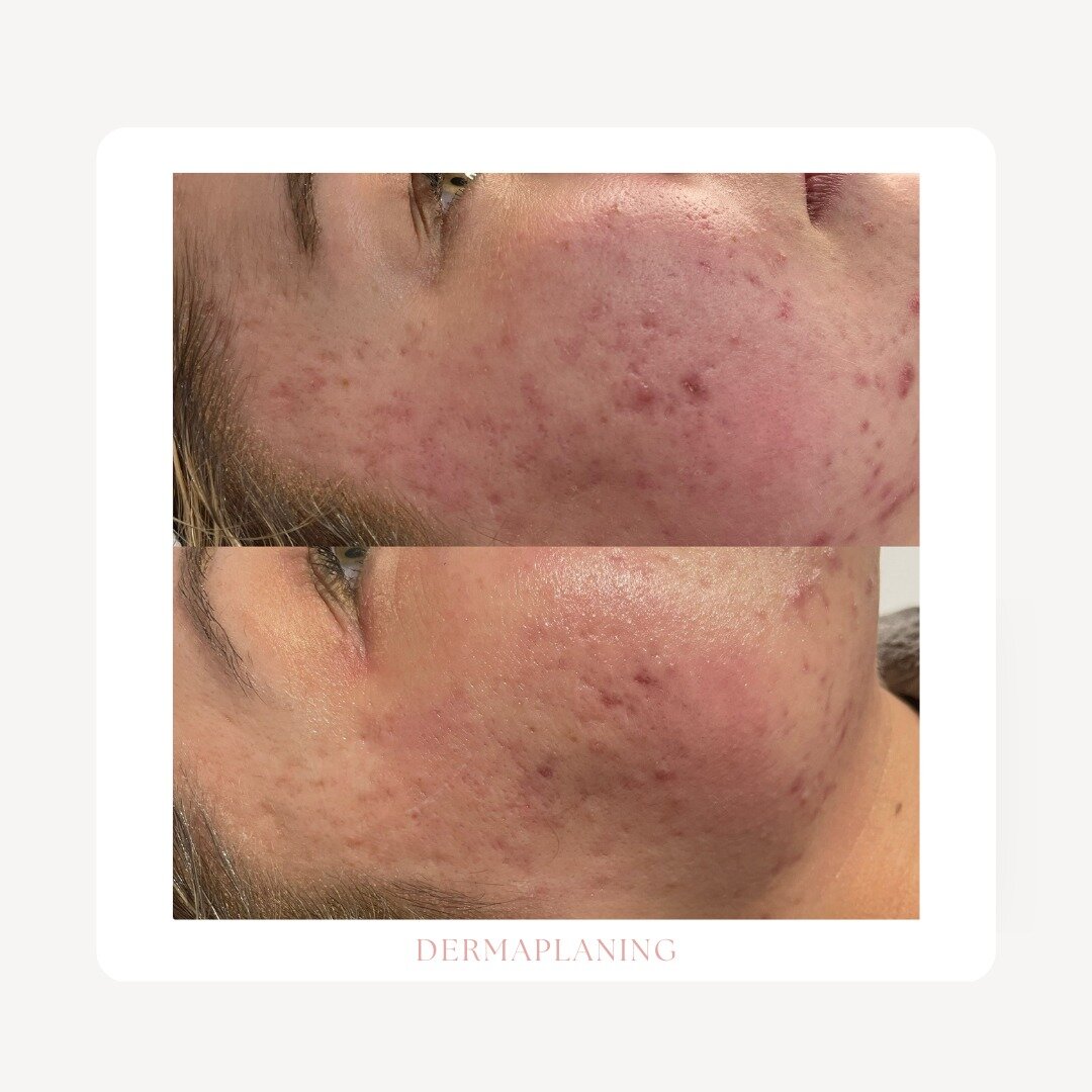 A transformative derma planing and skin peel for our client. An extremely convenient cosmetic procedure using a surgical blade to skim dead skin cells from your face. It helps to exfoliate and gets rid of dirt and vellus hair (peach fuzz). Not only d