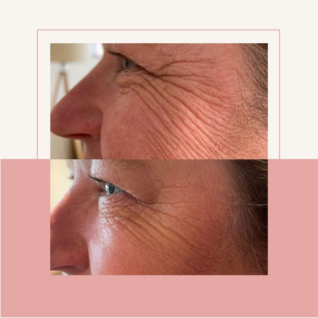 A very subtle anti wrinkle treatment to keep natural smile lines.

Book your appointment with Rachel and Lucy online.

#dermaplaning #dermaplane #skinpeel #aesthetics #skingoals #acnescarring #ghd #ghdproducts #ghdhairdryer #professionalhaircare #ghd
