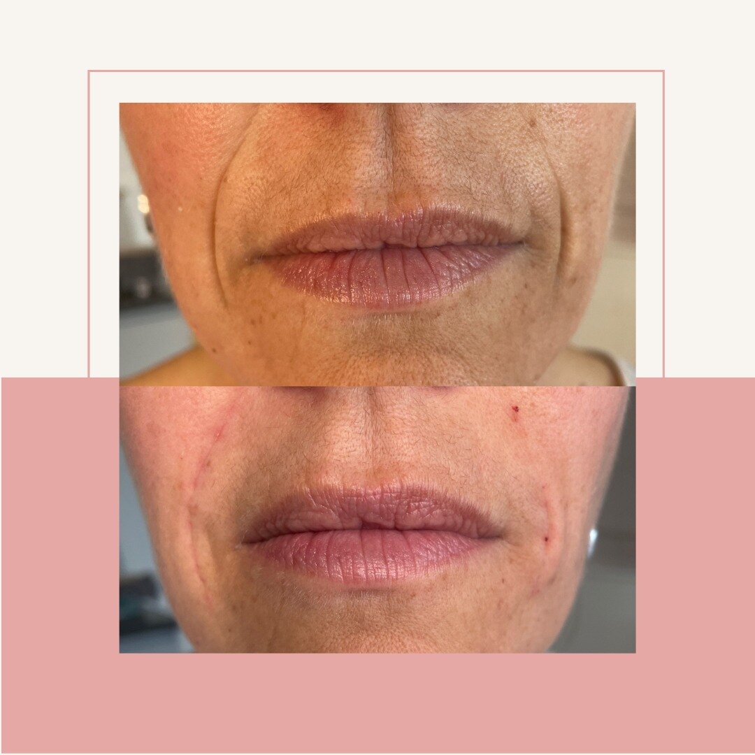 Our aestheticians treated the nasolabial lines by using dermal fillers to subtly reduce. Book online with Rachel and Lucy for your treatment.

#dermaplaning #dermaplane #skinpeel #aesthetics #skingoals #acnescarring #ghd #ghdproducts #ghdhairdryer #p