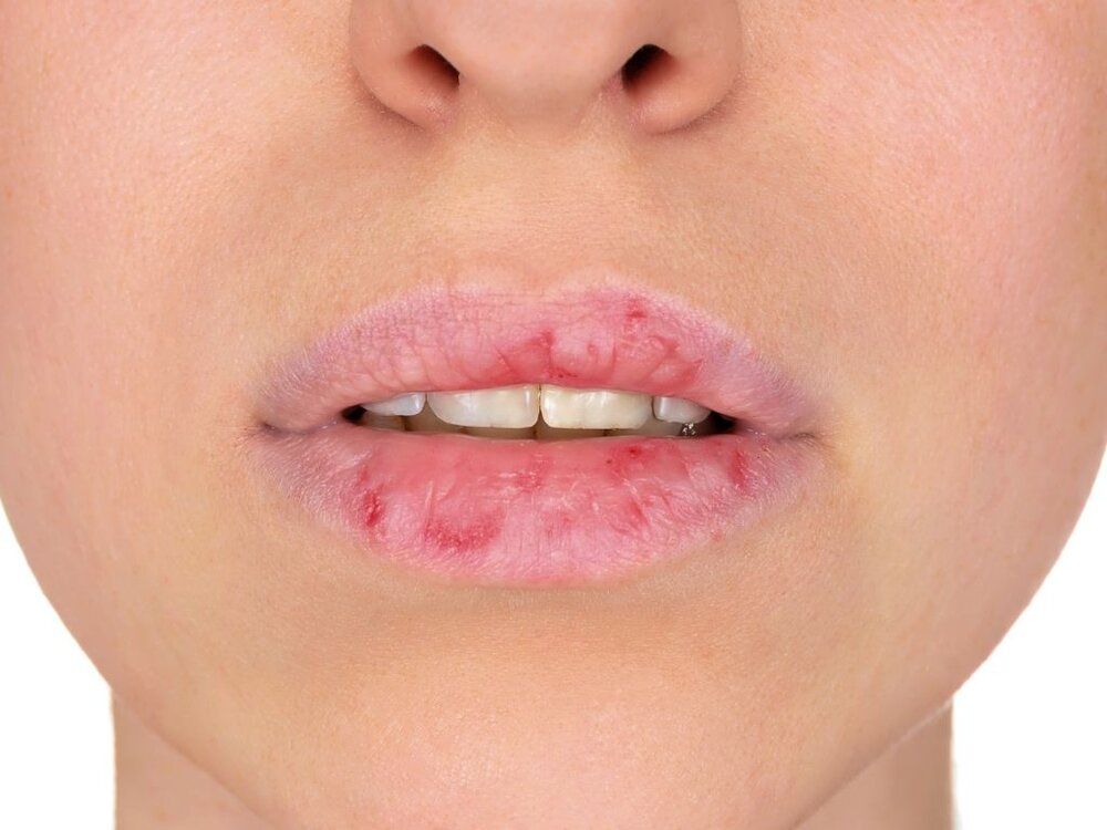 Dry, Chapped and Cracked Lips — Waterview Dental